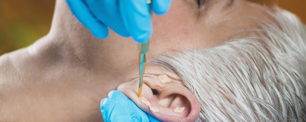 Auriculotherapy, or auricular treatment on human ear, close up. Therapist hand applying acupuncture ear seed sticker with tweezers.